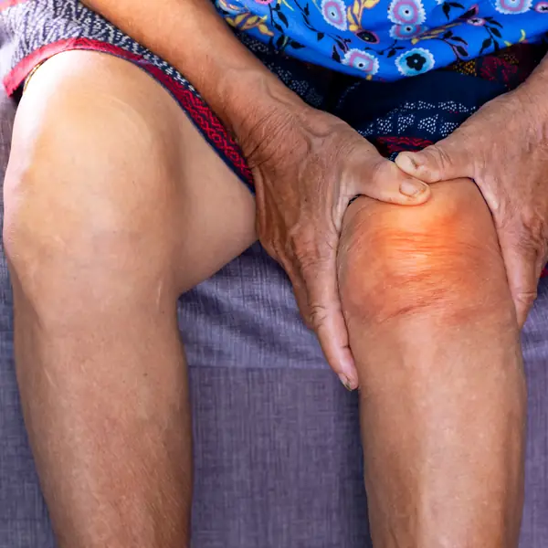 Persona mayor se sujeta la rodilla inflamada por dolor articular