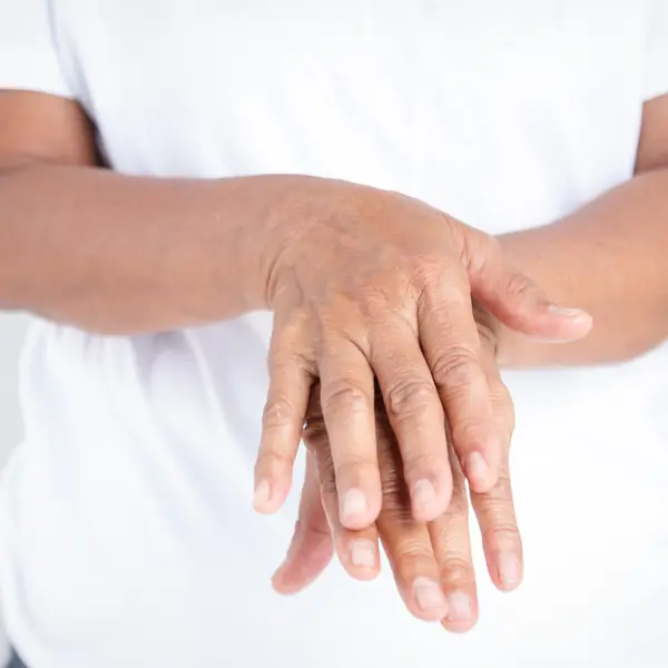 Manos de una persona con artritis reumatoide